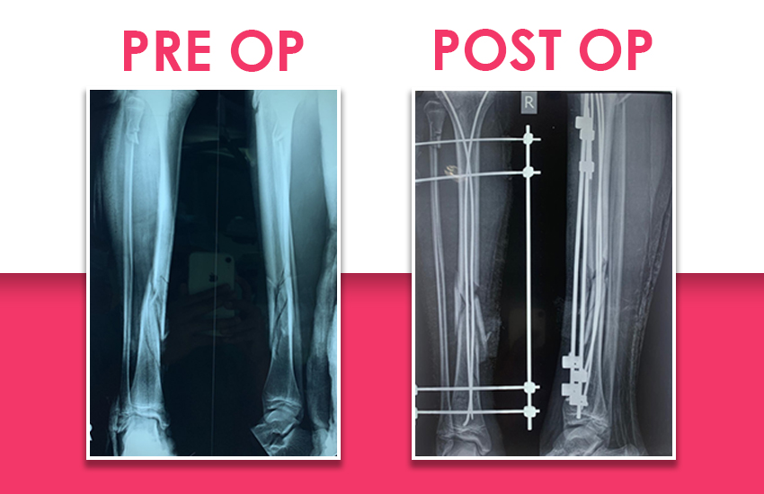 Pre - Post Op Images Of Open Tibia Fracture