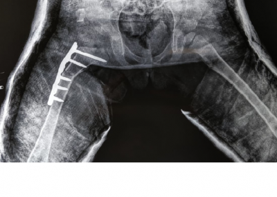 Hip Dysplasia In Infants Treatment In Vadodara