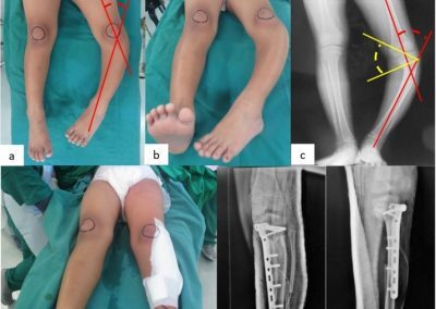 Limb Deformity Correction Treatment In Vadodara