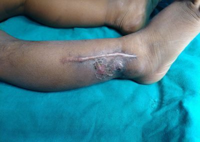 Child Septic Arthritis Treatment By Child Ortho Care Clinic