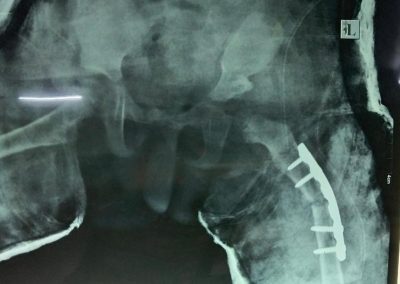 Hip Dysplasia In Infants Treatment By Child Orthopedic Surgeon