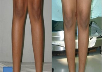 Limb Deformity Correction by Paediatrics Ortho in Vadodara