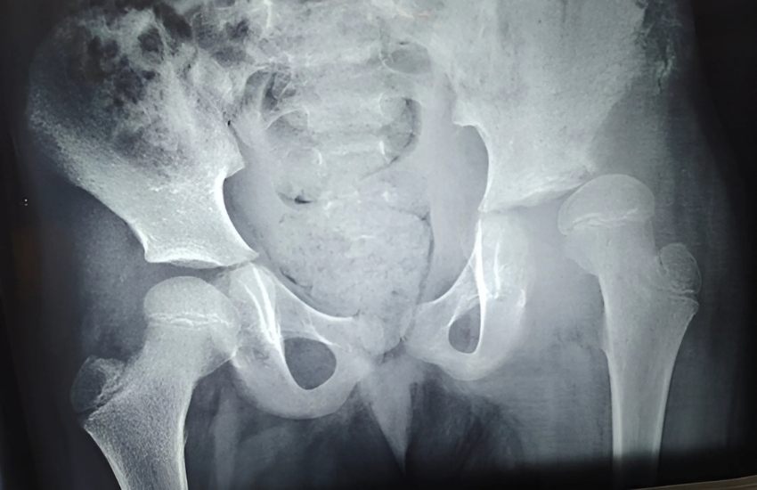 Hip Joint Treatment By Paediatric Orthopaedic Surgeon