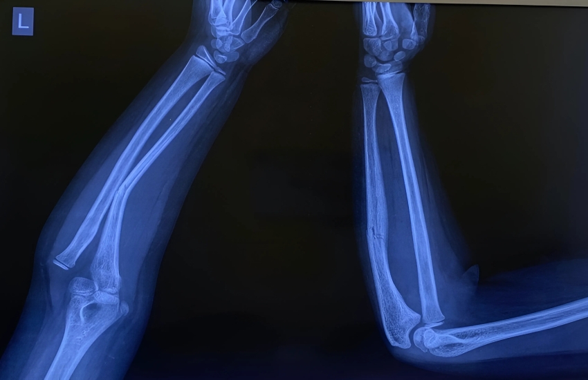 Monteggia Fracture Dislocation By Bone Doctor In Vadodara