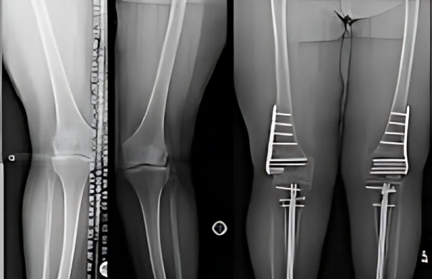 Limb Deformity Correction in Vadodara