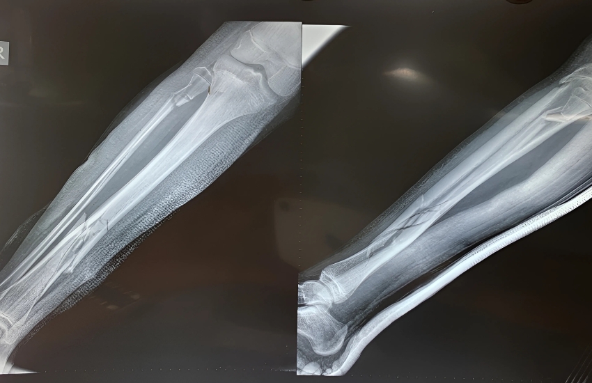 Pre - Post Op Images Of Open Tibia Fracture