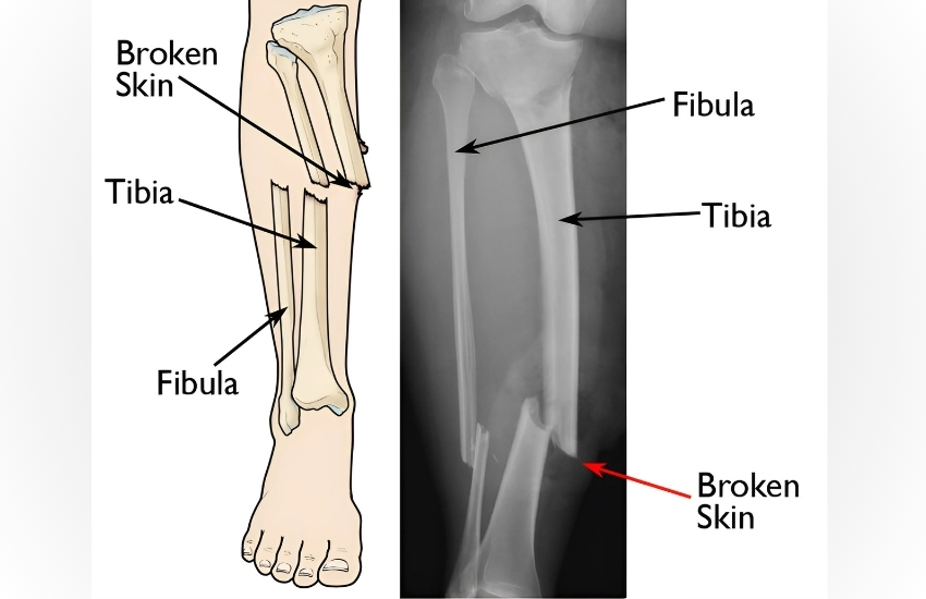 After images of Treatment by Paediatric Orthopaedic in Road Accident 