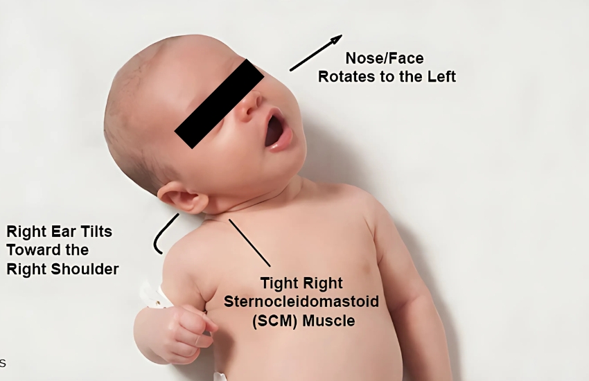 Torticollis Treatment In Vadodara