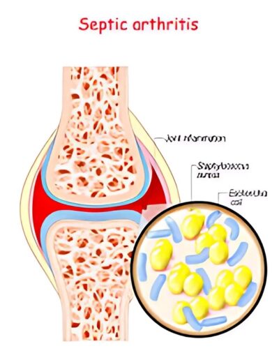 joints-and-bones-infection-gallery-2-400x516
