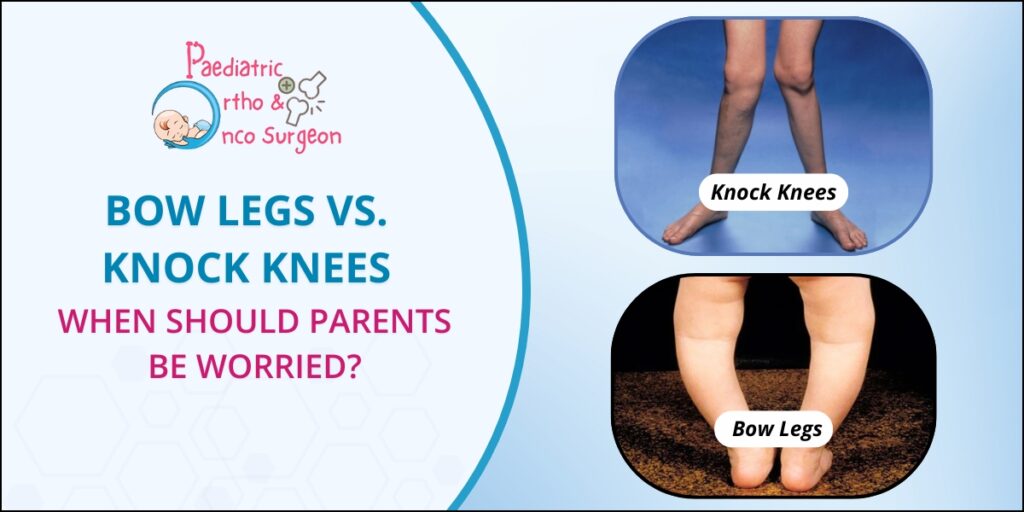 Knock Knee vs Bow Legs