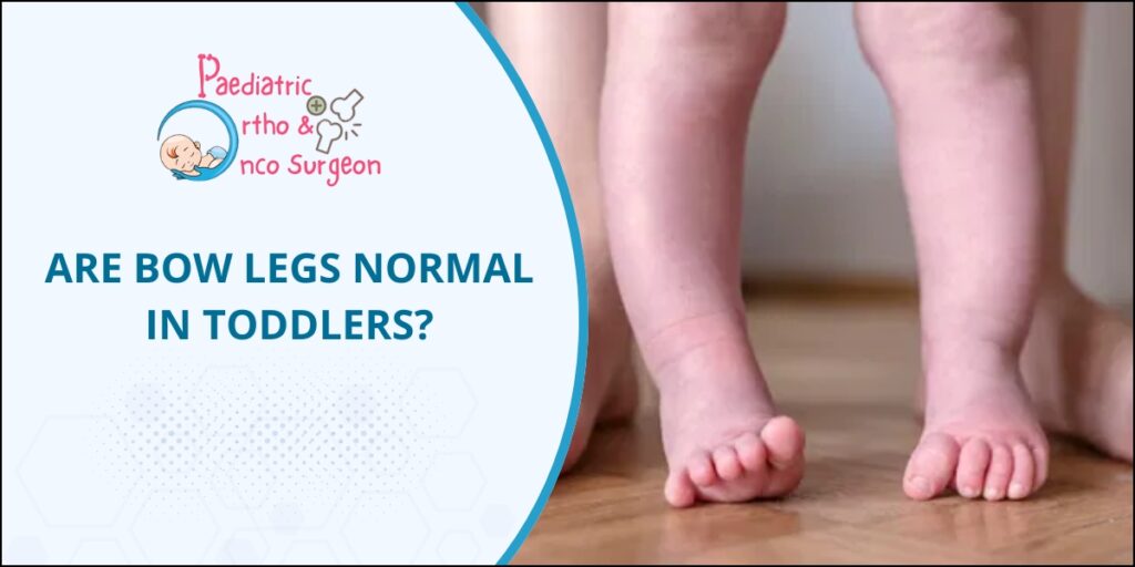 Bow legs in toddlers