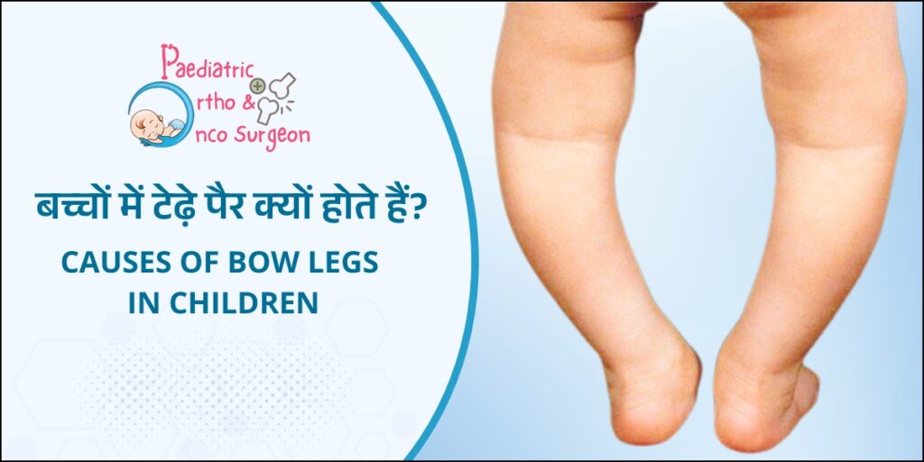 Bow Legs in Children