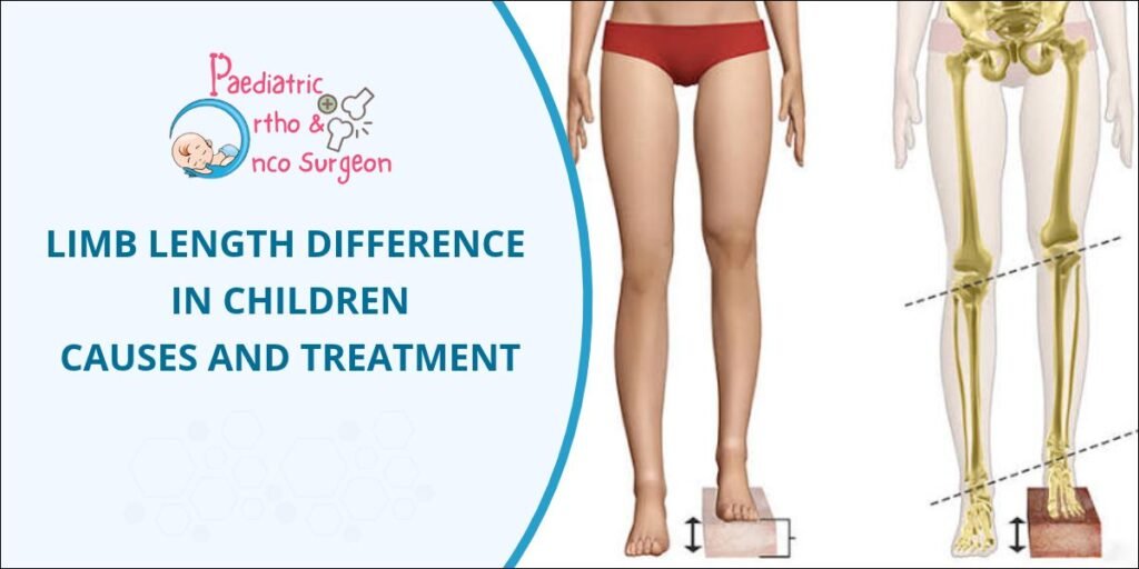 Limb Length Difference in Children